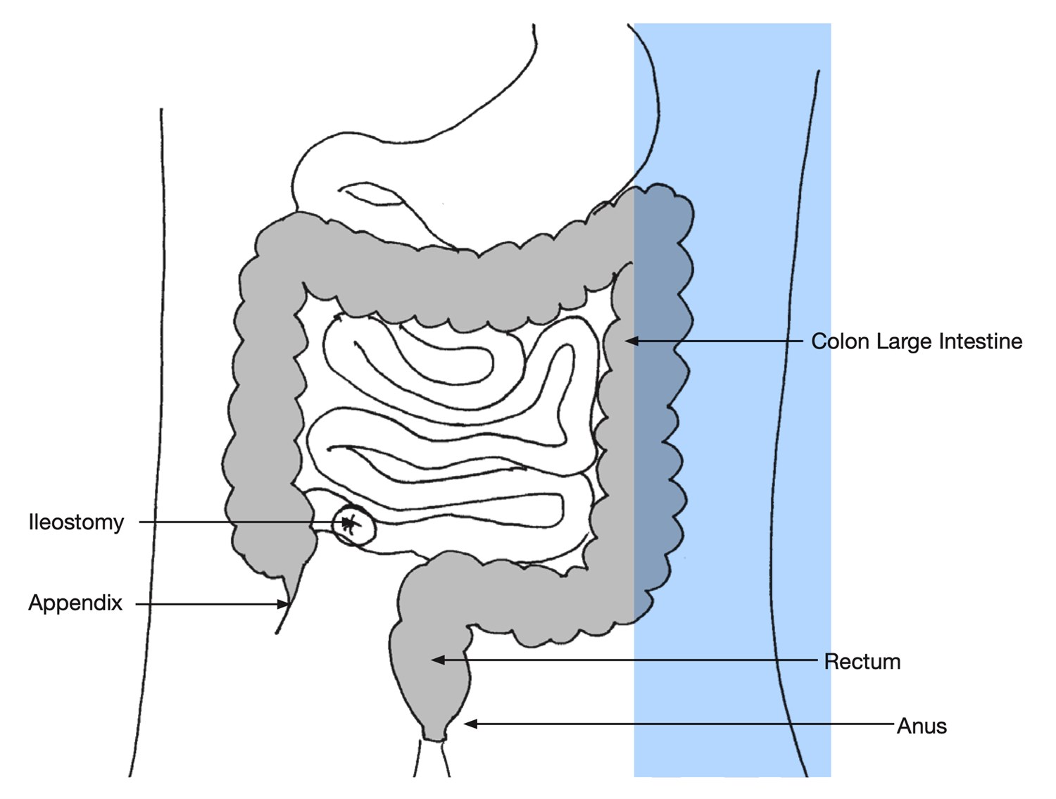 Ileostomy | UCSF Ostomy Education Portal