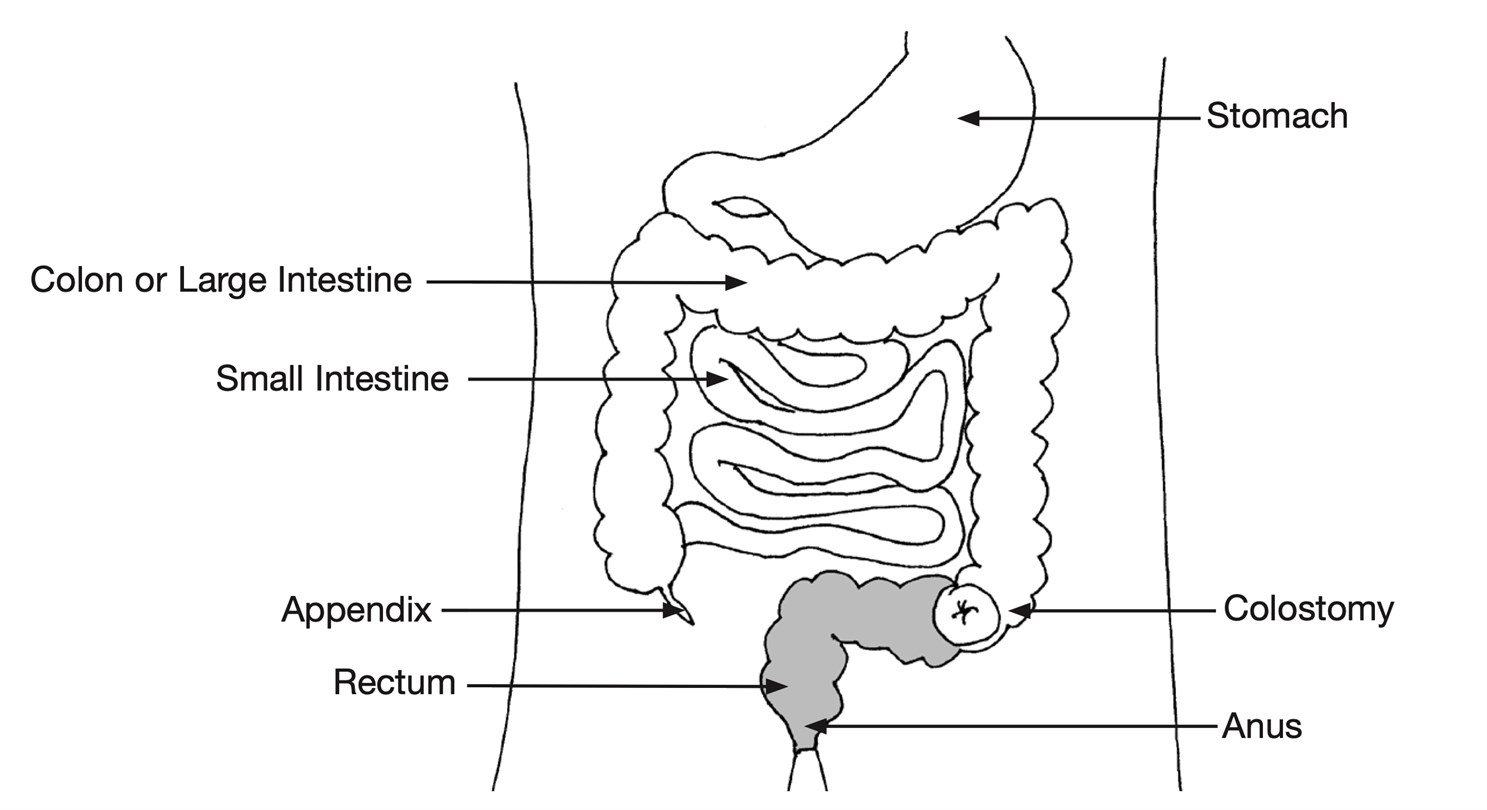 Colostomy